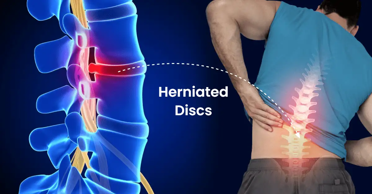 https://gradskivodic.rs/wp-content/uploads/2024/12/Herniateddiscs1.png